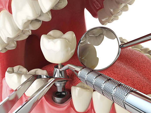 Best Emergency Root Canal Therapy in Glenrock, WY
